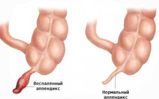 Из-за чего может появиться уплотнение возле пупка?
