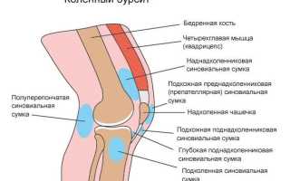 Эффективные методы лечения бурсита коленного сустава в домашних условиях