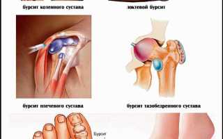 Что такое бурсит пятки. Причины, симптомы и лечение воспаления