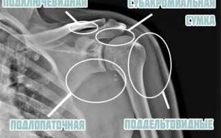 Лечение поддельтовидного бурсита плечевого сустава
