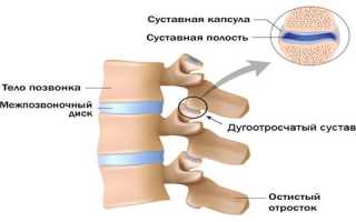 Как вылечить дугоотросчатые суставы позвоночника от артроза?