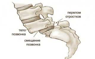 Симптомы и лечение смещения позвонков поясничного отдела