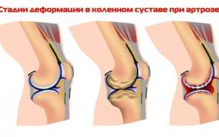 Питание при гонартрозе коленных суставов: меню что нельзя есть, а что можно