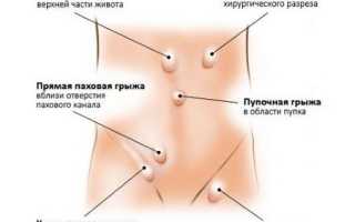 Дивертикулы двенадцатиперстной кишки — симптомы и лечение