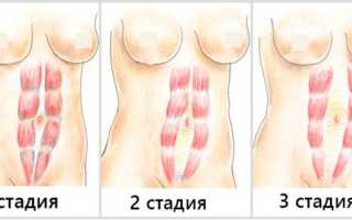 Как правильно тренироваться при диастазе