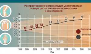 Симптомы, лечение и профилактика гонартроза коленного сустава 3 степени