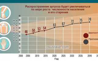 Симптомы, лечение и профилактика гонартроза коленного сустава 3 степени