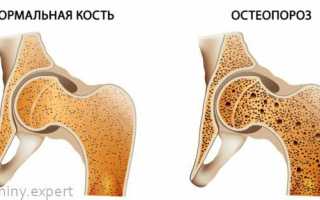 Какие витамины нужно принимать при остеопорозе