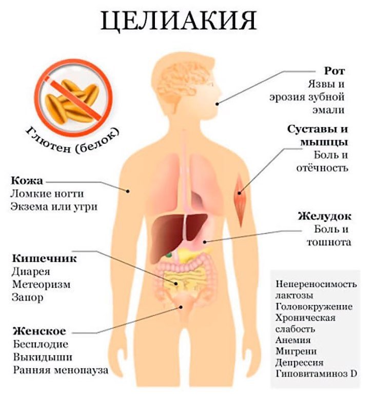 Симптомы непереносимости глютена