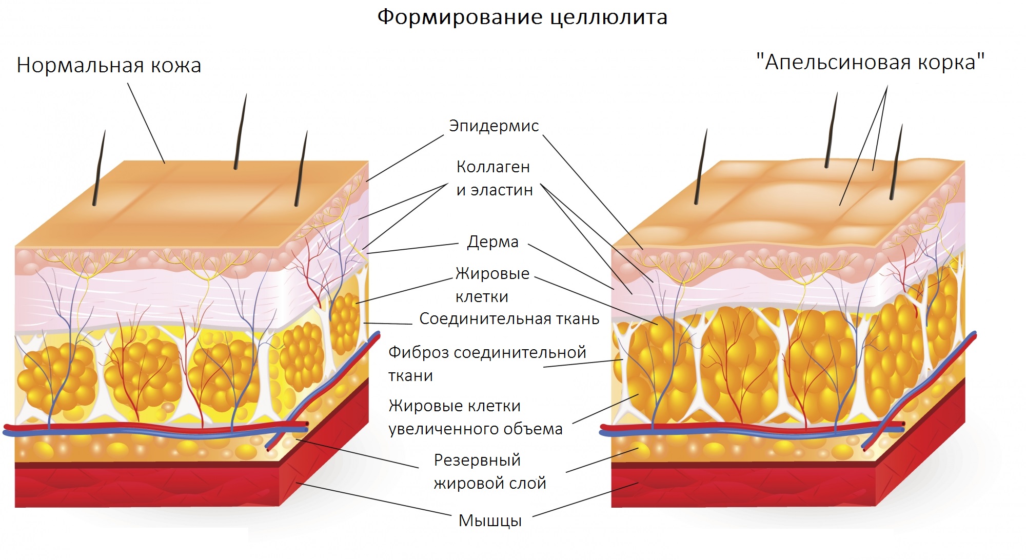 Формирование целлюлита